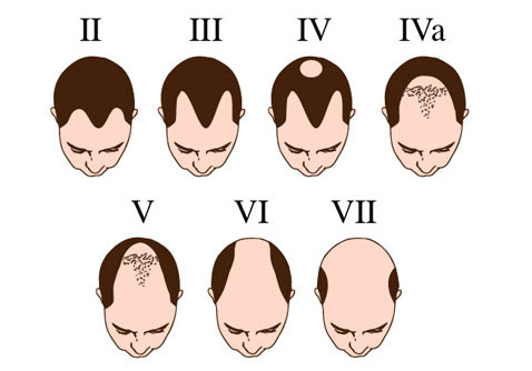 how to stop hair loss and regrow it the natural way